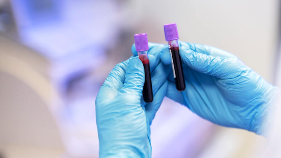 Monosit Nasıl Yükseltilir?