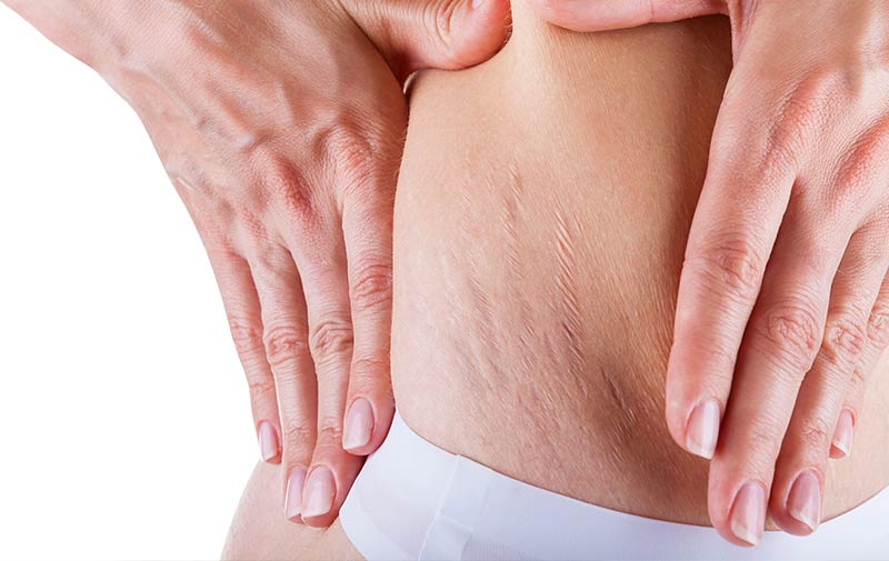 Karın çatlakları için alternatif çözümler