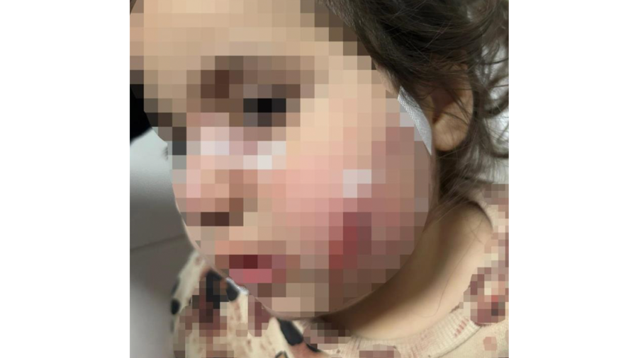 Köpek dehşeti: 3 yaşındaki Ada’nın yüzü pençe ve ısırıkla dolu 
