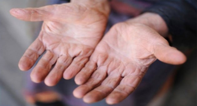 Mor ve Kırmızı Döküntülere Dikkat! | TurkArama Motoru | Sağlık ve Günlük Yaşam için Pratik Bilgiler